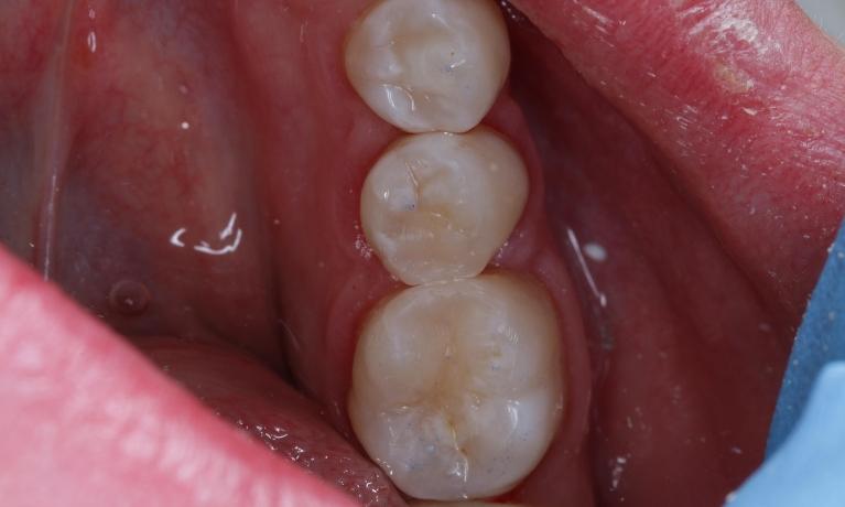 Tooth-Coloured-Fillings-Repair-After-Image