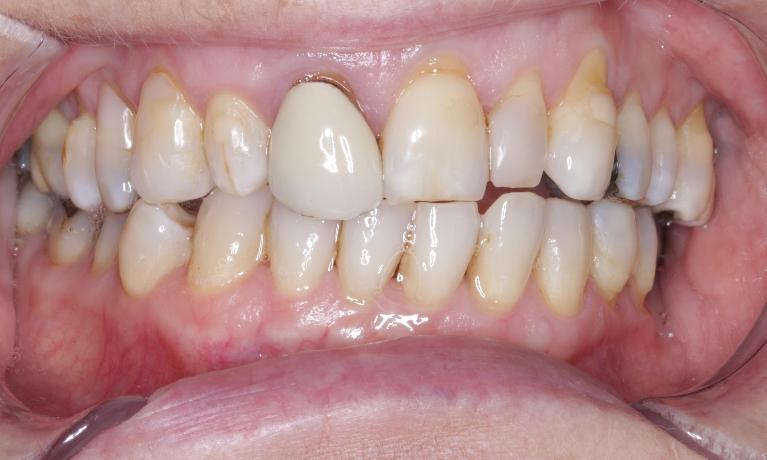 Repair-of-Porcelain-Crown-Before-Image