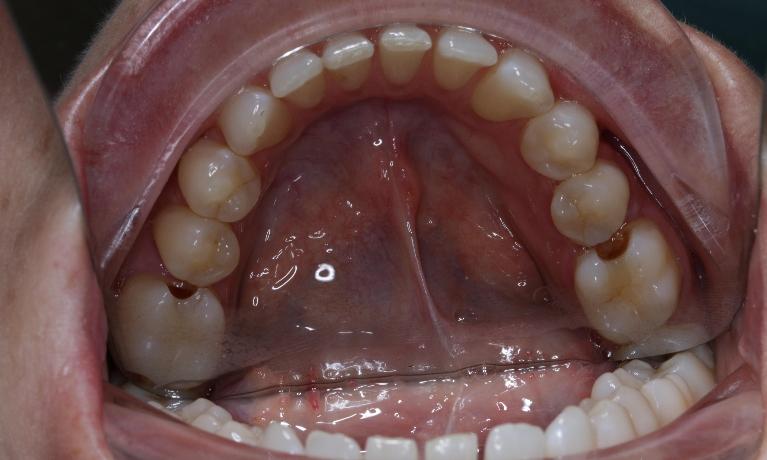 Tooth-Coloured-Fillings-Repair-Before-Image